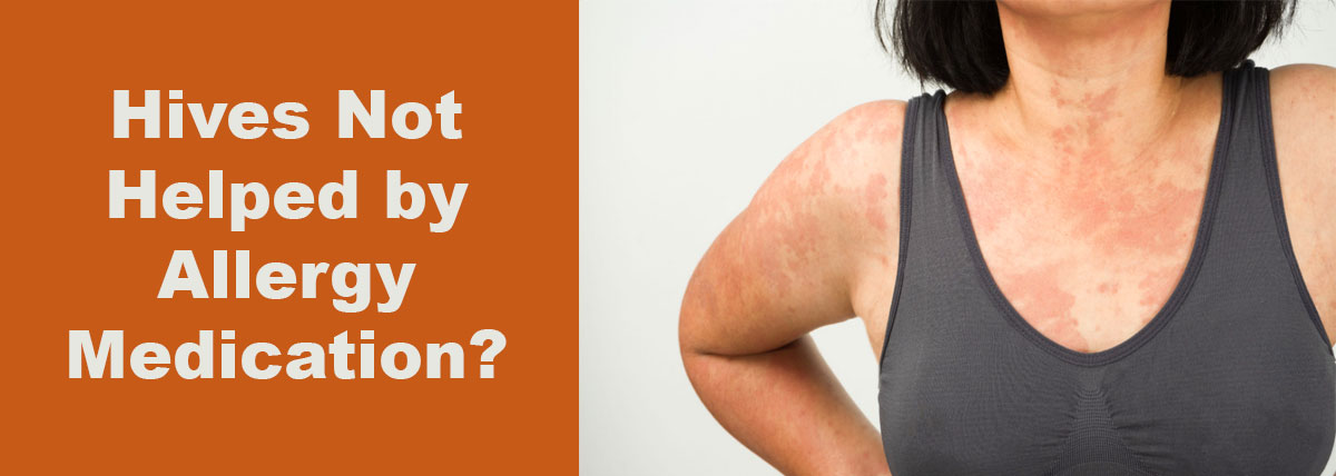 Hives Not Helped by Allergy Medication?